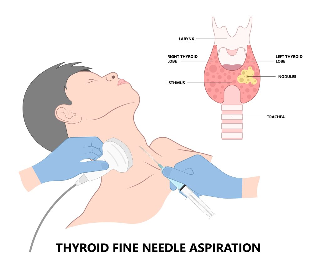 Aspiration biopsy elite diagnostic