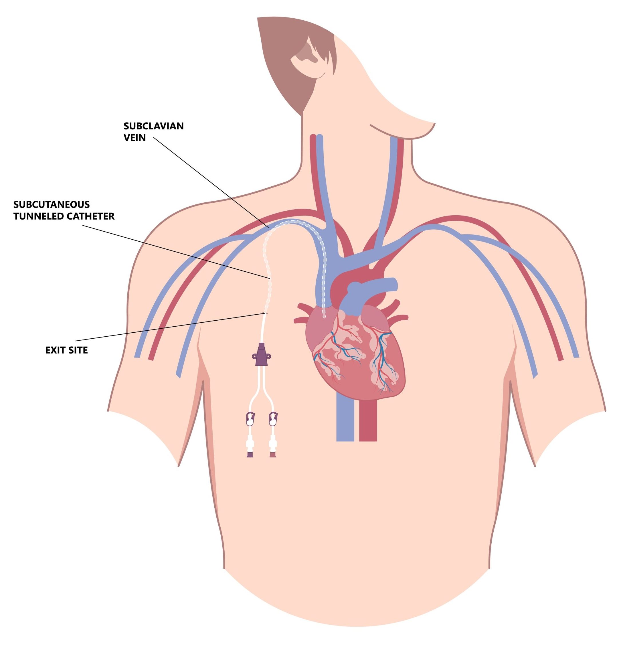 Subcutaneous Port Placement 