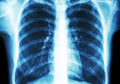 Film,Chest,X-ray,Pa,Upright,:,Show,Normal,Human's,Chest